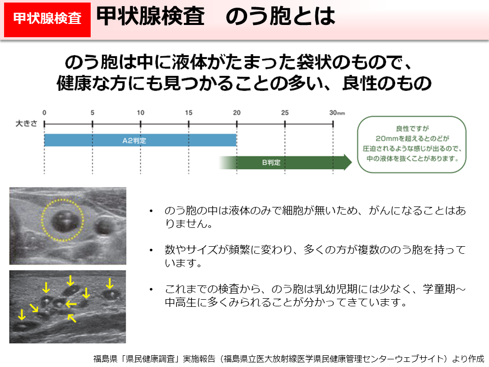 甲状腺検査　のう胞とは