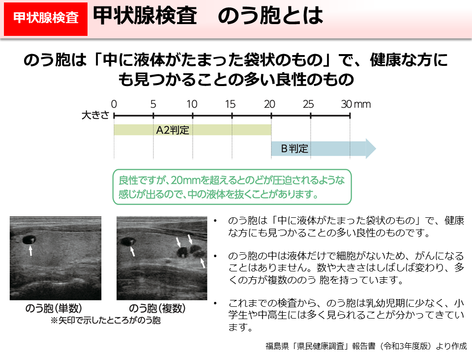 甲状腺検査　のう胞とは