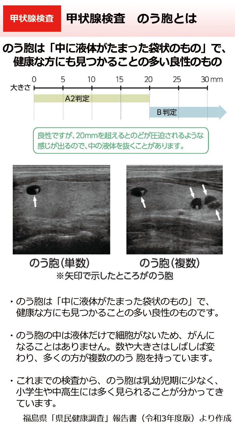 甲状腺検査　のう胞とは