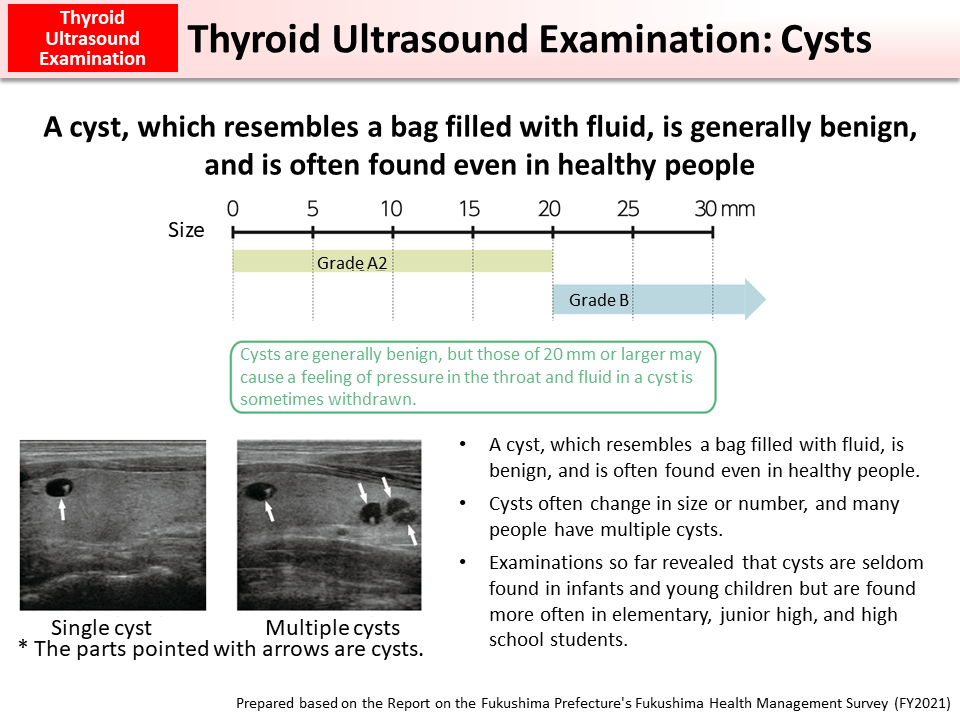 Thyroid Ultrasound Examination: Cysts_Figure